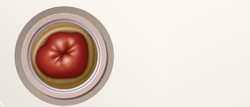 an illustration of a stoma