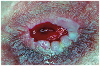 Pseudoverrucous Lesions (Hyperplasia commonly called PEH)